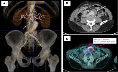 Homemade pericardial bifurcated graft for Q fever-infected abdominal aortic aneurysm open repair: a case report